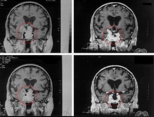 tumor-pituitary